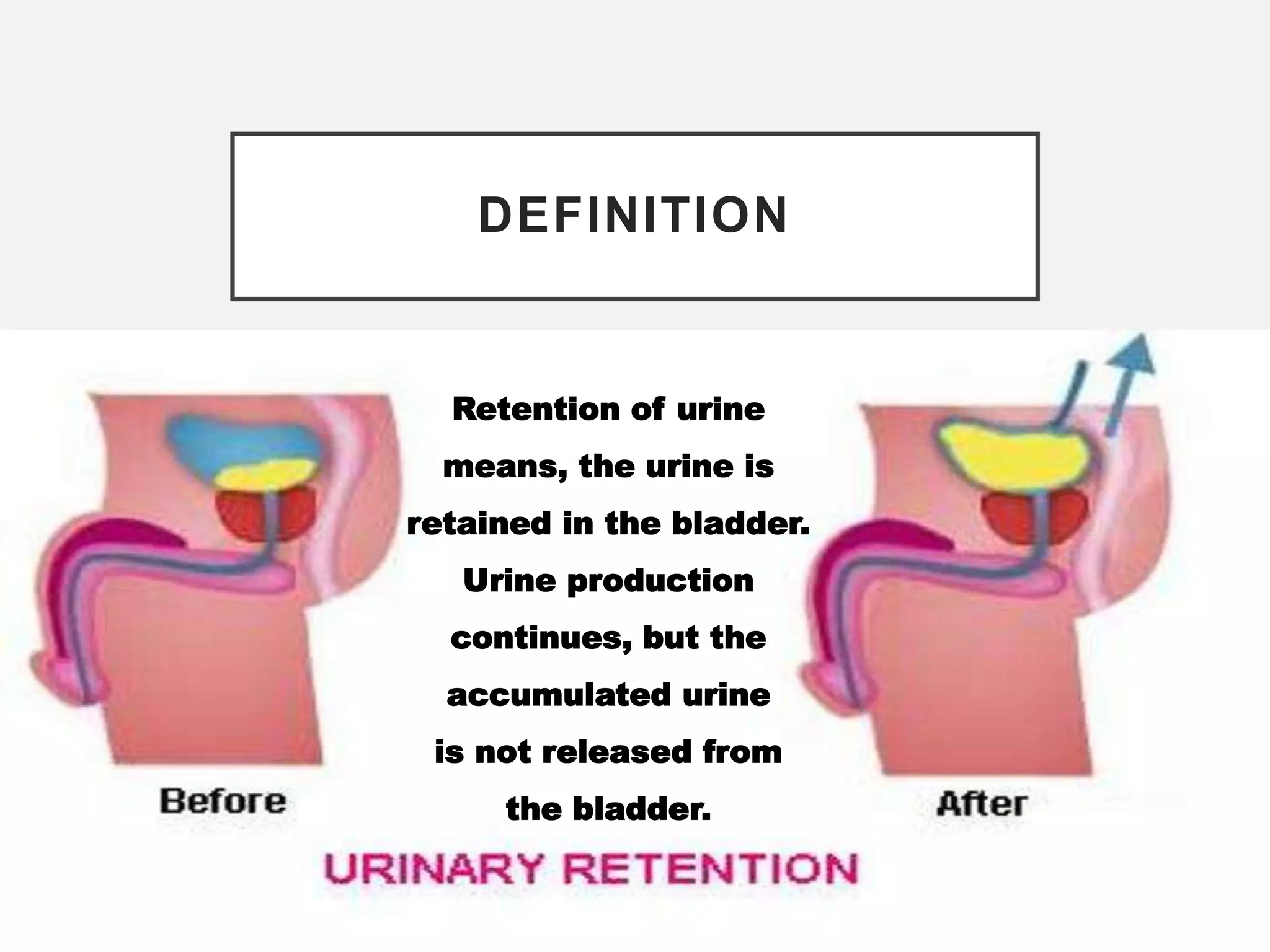 Define Incontinent Retension & Incontinence of Urine.pptx