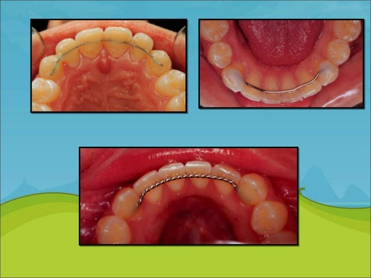 Retention and Relapse in orthodontics