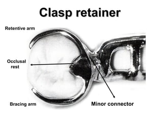 Clasp retainerClasp retainer
Retentive arm
Bracing arm
Occlusal
rest
Minor connector
 