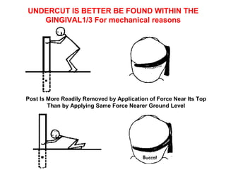 UNDERCUT IS BETTER BE FOUND WITHIN THE
GINGIVAL1/3 For mechanical reasons
Post Is More Readily Removed by Application of Force Near Its Top
Than by Applying Same Force Nearer Ground Level
 