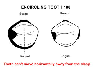 180ENCIRCLING TOOTH
continuous intermittent
Tooth can't move horizontally away from the clasp
 