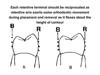 Each retentive terminal should be reciprocated as
retentive arm exerts some orthodontic movement
during placement and removal as it flexes about the
height of contour
 