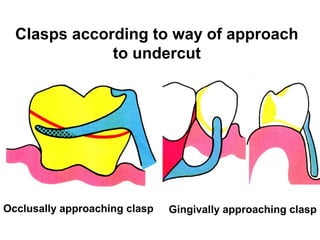 Occlusally approaching clasp Gingivally approaching clasp
Clasps according to way of approach
to undercut
 