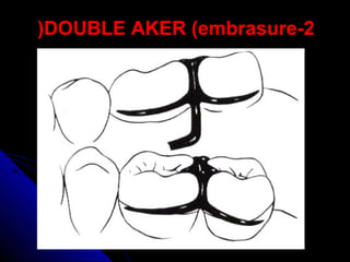 2-DOUBLE AKER (embrasure(
 