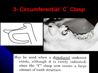 3- Circumferential `C` Clasp3- Circumferential `C` Clasp
 