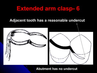 6-Extended arm clasp
Abutment has no undercut
Adjacent tooth has a reasonable undercut
 