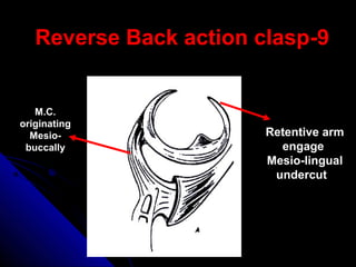 99--Reverse Back action claspReverse Back action clasp
M.C.
originating
Mesio-
buccally
Retentive arm
engage
Mesio-lingual
undercut
 