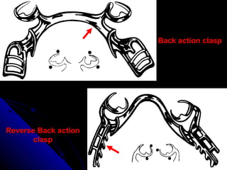 Reverse Back actionReverse Back action
claspclasp
Back action claspBack action clasp
 