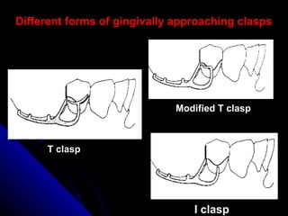 T clasp
Modified T clasp
Different forms of gingivally approaching claspsDifferent forms of gingivally approaching clasps
I clasp
 