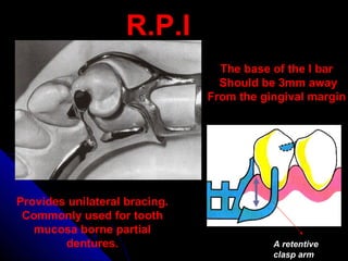 R.P.I
The base of the I bar
Should be 3mm away
From the gingival margin
Provides unilateral bracing.
Commonly used for tooth
mucosa borne partial
dentures. A retentive
clasp arm
 