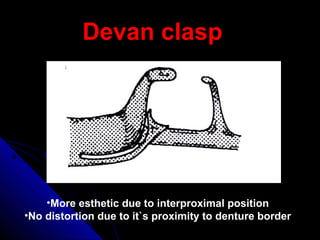 Devan clasp
•More esthetic due to interproximal position
•No distortion due to it`s proximity to denture border
 