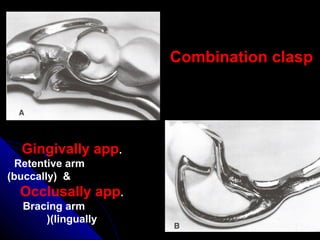 Combination clasp
Gingivally app.
Retentive arm
(buccally) &
Occlusally app.
Bracing arm
(lingually)
 