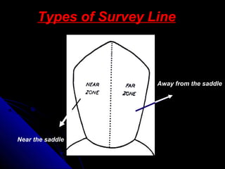 Types of Survey Line
Near the saddle
Away from the saddle
 