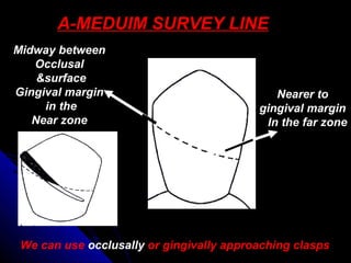 A-MEDUIM SURVEY LINE
Midway between
Occlusal
surface&
Gingival margin
in the
Near zone
Nearer to
gingival margin
In the far zone
We can use occlusally or gingivally approaching clasps
 
