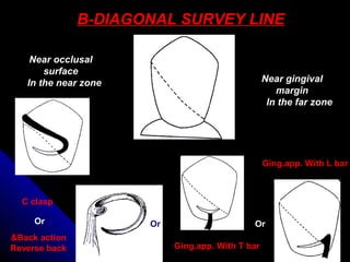 B-DIAGONAL SURVEY LINE
Near occlusal
surface
In the near zone Near gingival
margin
In the far zone
Or Or Or
Back action&
Reverse back
C clasp
Ging.app. With T bar
Ging.app. With L bar
 
