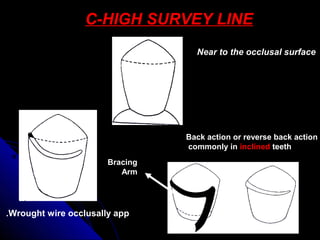 C-HIGH SURVEY LINE
Near to the occlusal surface
Wrought wire occlusally app.
Back action or reverse back action
commonly in inclined teeth
Bracing
Arm
 