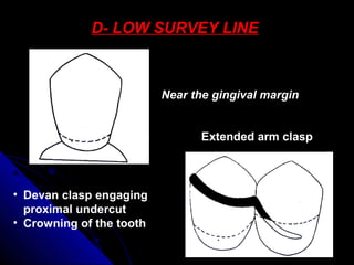 D- LOW SURVEY LINE
Near the gingival margin
Extended arm clasp
• Devan clasp engaging
proximal undercut
• Crowning of the tooth
 