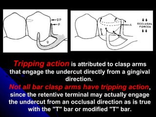 Tripping action is attributed to clasp arms
that engage the undercut directly from a gingival
direction.
Not all bar clasp arms have tripping action,
since the retentive terminal may actually engage
the undercut from an occlusal direction as is true
with the "T" bar or modified "T" bar.
 