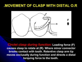 MOVEMENT OF CLASP WITH DISTAL O.R.
Circlet clasp during function: Loading force (F)
causes clasp to rotate at (R). Where minor connector
breaks contact with tooth. Retentive clasp arm tip
moves occlusally during function and directs a distal
torquing force to the tooth.
 
