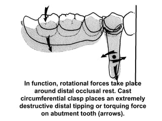 In function, rotational forces take place
around distal occlusal rest. Cast
circumferential clasp places an extremely
destructive distal tipping or torquing force
on abutment tooth (arrows).
 