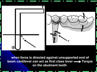 when force is directed against unsupported end of
beam cantilever can act as first class lever Torque
on the abutment tooth
F
 