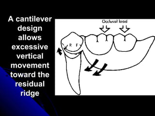 A cantileverA cantilever
designdesign
allowsallows
excessiveexcessive
verticalvertical
movementmovement
toward thetoward the
residualresidual
ridgeridge
 