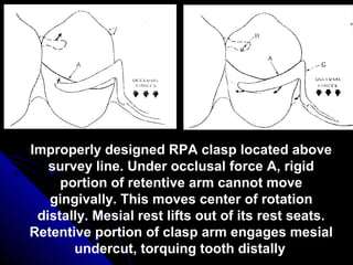 Improperly designed RPA clasp located above
survey line. Under occlusal force A, rigid
portion of retentive arm cannot move
gingivally. This moves center of rotation
distally. Mesial rest lifts out of its rest seats.
Retentive portion of clasp arm engages mesial
undercut, torquing tooth distally
 