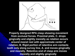 Properly designed RPA clasp showing movement
from occlusal forces. Proximal plate, C. drops
gingivally and slightly mesially as rotation occurs
around mesial rest with approximate center of
rotation, B. Rigid portion of retentive arm contacts
tooth only along survey line, A. and moves gingivally
and mesially. Retentive end of clasp arm moves
mesially and slightly gingivally
 