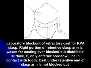Laboratory blockout of refractory cast for RPA
clasp. Rigid portion of retentive clasp arm is
waxed for casting over blocked-out distofacial
surface, E, only anterior border will be in
contact with tooth. Cast under retentive end of
clasp arm is not blocked out
 