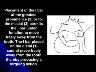 Placement of the I bar
at the greatest
prominence (2) or to
the mesial (3) permits
the I bar under
function to move
freely away from the
tooth. The I bar placed
on the distal (1)
cannot move freely
away from the tooth
thereby producing a
torquing action
 