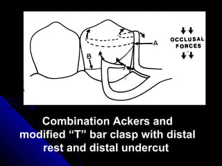 Combination Ackers and
modified “T” bar clasp with distal
rest and distal undercut
 