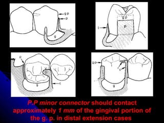 P.P minor connector should contact
approximately 1 mm of the gingival portion of
the g. p. in distal extension cases
 