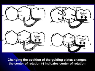 Changing the position of the guiding plates changes
the center of rotation (.
) indicates center of rotation
 
