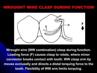 WROUGHT WIRE CLASP DURING FUNCTION
Wrought wire (WW combination) clasp during function.
Loading force (F) causes clasp to rotate, where minor
connector breaks contact with tooth. WW clasp arm tip
moves occlusally and directs a distal torquing force to the
tooth. Flexibility of WW arm limits torquing.
 
