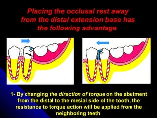Placing the occlusal rest away
from the distal extension base has
the following advantage
1- By changing the direction of torque on the abutment
from the distal to the mesial side of the tooth, the
resistance to torque action will be applied from the
neighboring teeth
 