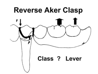 Reverse Aker Clasp
F
Class ? Lever
 