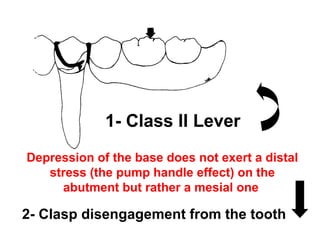 Depression of the base does not exert a distal
stress (the pump handle effect) on the
abutment but rather a mesial one
2- Clasp disengagement from the tooth
1- Class II Lever
 