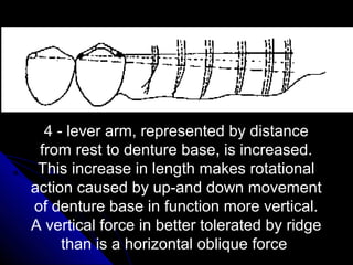 4 - lever arm, represented by distance
from rest to denture base, is increased.
This increase in length makes rotational
action caused by up-and down movement
of denture base in function more vertical.
A vertical force in better tolerated by ridge
than is a horizontal oblique force
 