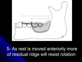 5- As rest is moved anteriorly more
of residual ridge will resist rotation
 