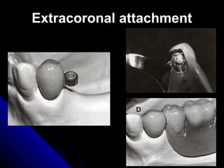 Extracoronal attachmentExtracoronal attachment
 