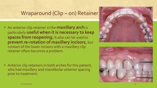 Wraparound (Clip – on) Retainer
▪ An anterior clip retainer in the maxillary arch is
particularly useful when it is necessary to keep
spaces from reopening. It also can be used to
prevent re-rotation of maxillary incisors, but
contact of the lower incisors with a maxillary clip
retainer often becomes a problem.
▪ Anterior clip retainers in both arches for this patient,
who had maxillary and mandibular anterior spacing
prior to treatment.
S.S Hotchandani 33
 