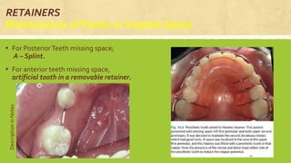 RETAINERS
Maintenance of Pontic or Implant Space
▪ For PosteriorTeeth missing space;
A – Splint.
▪ For anterior teeth missing space,
artificial tooth in a removable retainer.
DescriptioninNotes
S.S Hotchandani 45
 