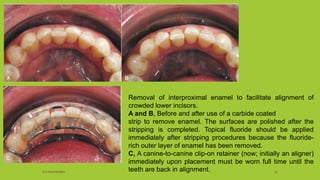 Removal of interproximal enamel to facilitate alignment of
crowded lower incisors.
A and B, Before and after use of a carbide coated
strip to remove enamel. The surfaces are polished after the
stripping is completed. Topical fluoride should be applied
immediately after stripping procedures because the fluoride-
rich outer layer of enamel has been removed.
C, A canine-to-canine clip-on retainer (now; initially an aligner)
immediately upon placement must be worn full time until the
teeth are back in alignment.S.S Hotchandani 51
 