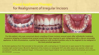 Fixed ApplianceTherapy
for Realignment of Irregular Incisors
For this patient, who was concerned about crowding of lower incisors several years after orthodontic treatment,
excessive stripping of interproximal enamel would have been required to gain realignment with a clip-on removable
appliance. In that circumstance, a partial fixed appliance with bonded brackets only on the segment to be realigned is
the most practical approach.
A, Bonded appliance from first premolar to first premolar, with a coil spring on 16 steel wire to open space for the rotated and
crowded right central incisor. B and C, Alignment of the incisors on rectangular NiTi wire after space was opened, which was
completed 4 months after treatment began. At this point a fixed lingual retainer can be bonded before the brackets and archwire
are removed. S.S Hotchandani 53
 