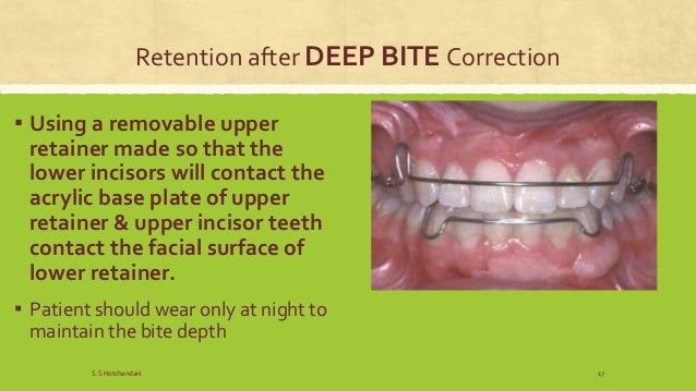 retention orthodontics dentistry appliance correction upper retainer
