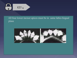 Lower Apices Retention-and-Relapse- for dental medicine students.pptx