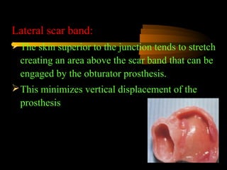 Lateral scar band:
The skin superior to the junction tends to stretch
creating an area above the scar band that can be
engaged by the obturator prosthesis.
This minimizes vertical displacement of the
prosthesis
 