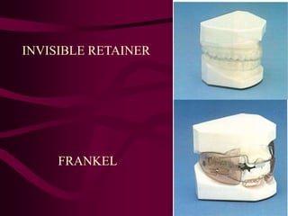 INVISIBLE RETAINER
FRANKEL
 