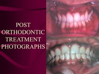 POST
ORTHODONTIC
TREATMENT
PHOTOGRAPHS
 