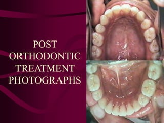 POST
ORTHODONTIC
TREATMENT
PHOTOGRAPHS
 